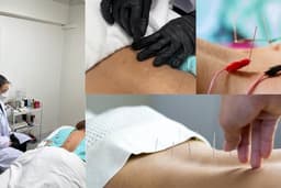 Dry Needling Therapy – ฝังเข็ม ย่านท่าพระ จรัญสนิทวงศ์