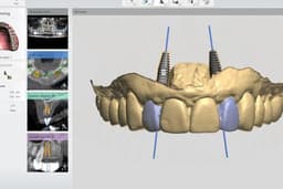 ให้คำปรึกษาการวางแผนผ่าตัดรากฟันเทียม (Dental implant)